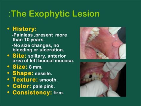 Oral medicine case(fibro-epithelial polyp)