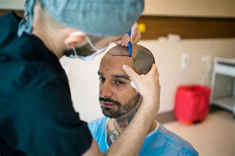 The 9 Hair transplant clinics in Turkey that offer affordable procedures - Wales Online