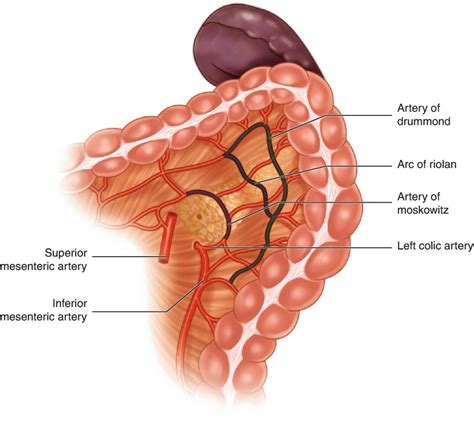 Program Colorectal Pathway: Laparoscopic Splenic Flexure Release (Tips ...