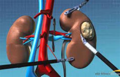 Robotic IVC thrombectomy not inferior to standard open IVC thrombectomy for kidney cancer