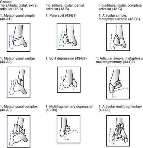 Pilon Fractures | Musculoskeletal Key