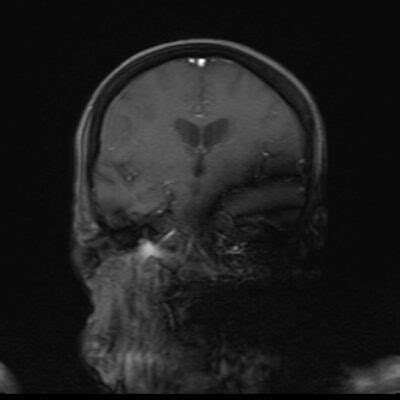 Metal \Titanium Artifact MRI | Magnetic Susceptibility Artifact MRI