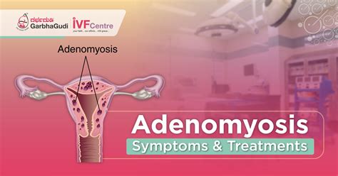 Adenomyosis Symptoms & Treatments