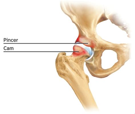 Impingement der Hüfte durch Hüftarthroskopie behandeln