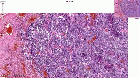 Small Cell Carcinoma Histology