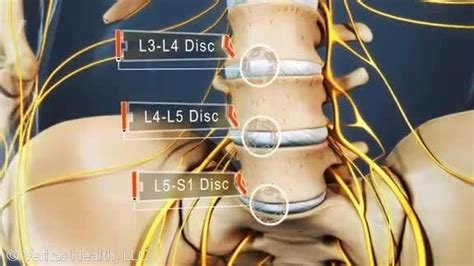 Lumbar Spine L3-L4 Disc, L4-L5 Disc, and L5-S1 Disc | Lumbar disc, Bulging disc, Degenerative ...