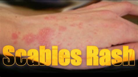 Scabies Rash On Face