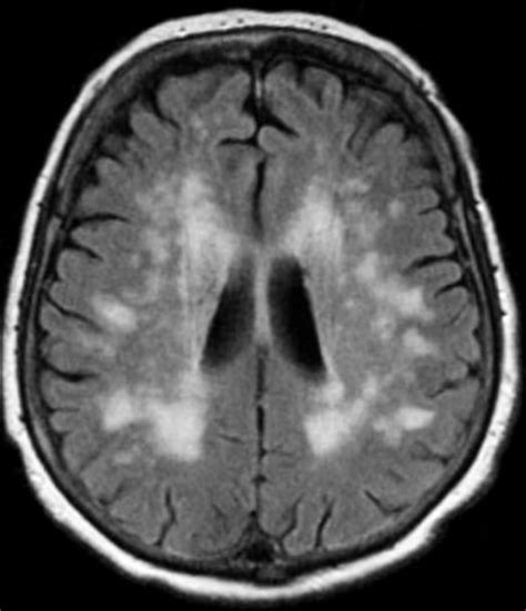 Chronic Diseases: Chronic White Matter Ischemic Disease