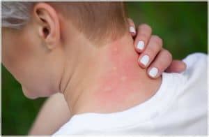 Skeeter Syndrome (In Adults) – Symptoms, Causes, Treatment, Prevention - Your Health Remedy