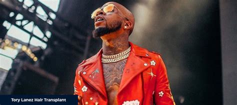 Tory Lanez Hair Transplant - Smile Hair Clinic