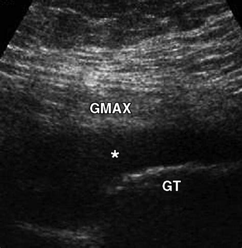 Greater Trochanteric Pain Syndrome Trochanteric Bursitis Shockwave ...