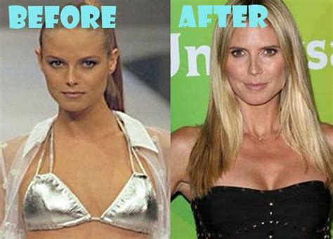 Heidi Klum Plastic Surgery Before and After Pictures | Plastic surgery, Celebrity plastic ...