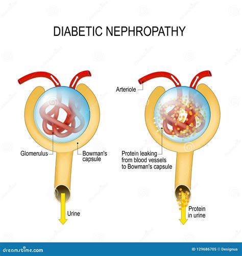 Diabetic Nephropathy. Diabetic Kidney Disease Stock Vector ...