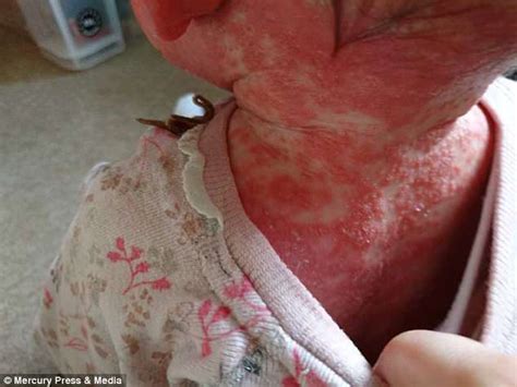 Girl, 2, has such bad psoriasis she 'looks like a little crab' and ...