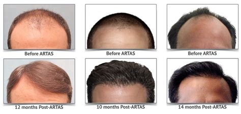 About ARTAS - The Hair Restoration Specialist... Tom Rosanelli, M.D.