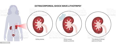 Lithotripsy Procedure Concept Stock Illustration - Download Image Now ...