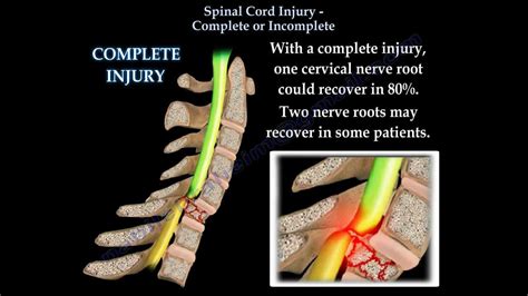 Spinal Cord Injury Complete Or Incomplete - Everything You Need To Know - Dr. Nabil Ebraheim ...