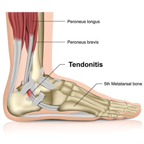 Peroneal Tendons - What are they? Best treatment options in 2023