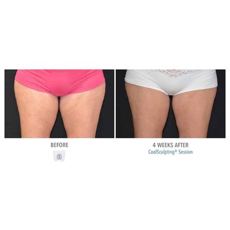 Best CoolSculpting Results in Alpharetta, GA at Sculpted Contours