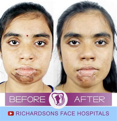 All You Must Know About Z Plasty Scar Revision – Richardson's Plastic ...