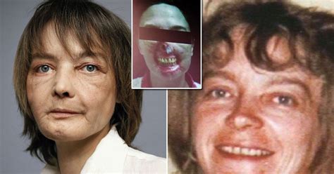 Woman who underwent the world’s first face transplant after horror dog ...