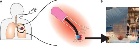 Interrogating Bronchoalveolar Lavage Samples via Exclusion-Based Analyte Extraction - Jacob J ...