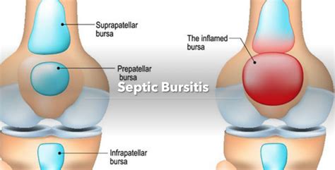 emDOCs.net – Emergency Medicine EducationSeptic Bursitis: ED Presentation, Evaluation, and ...