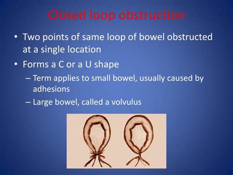 Closed Loop Vs Open Loop Bowel Obstruction