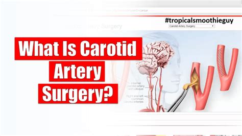 What Is Carotid Artery Surgery?