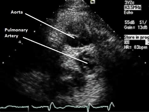 Transposition of the great vessels echocardiography or ultrasound - wikidoc