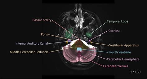 Cerebellum Anatomy Mri