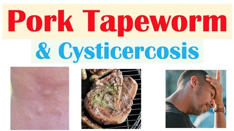 Pork Tapeworm (Taeniasis) | How It Infects, Symptoms & Cysticercosis, Diagnosis, Treatment - YouTube