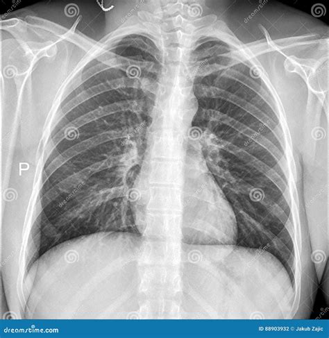 Chest Xray Of A Patient Showing Free Air In The Abdominal Cavity ...