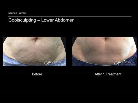 Before & After Photos Of Coolsculpting Treatment Results