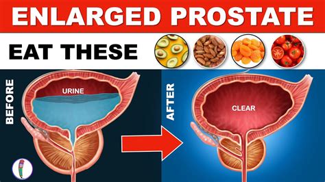 Prostate enlargement Treatment (Naturally) | Benign Prostatic Hyperplasia | Enlarged Prostate ...