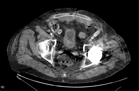 An adverse event of suprapubic catheter SPC insertion. A call for updating the existing ...