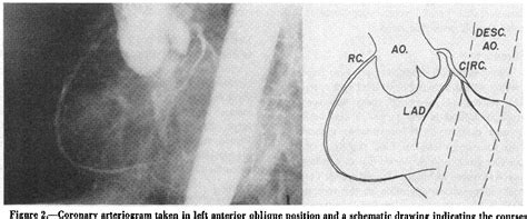 Figure 2 from Prinzmetal's variant of angina pectoris with only slight coronary atherosclerosis ...