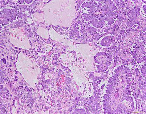 Qiao's Pathology: Mixed Germ Cell Tumor of the Testicle - a photo on ...