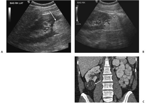 53 Renal Angiomyolipoma | Radiology Key