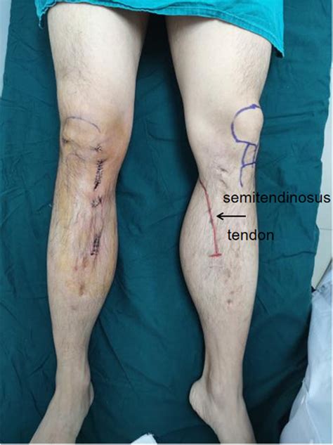 The red line shows the tibial attachment of the left semitendinosus tendon | Download Scientific ...