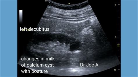 Milk of calcium cyst, effect of posture changes on ultrasound appearance, ultrasound video - YouTube