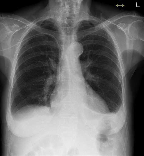 Pleural effusions - Radiology at St. Vincent's University Hospital