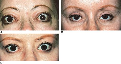 Thyroid-related orbitopathy - American Academy of Ophthalmology