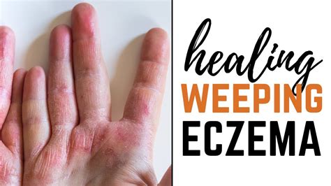 Dealing with Weeping Eczema: Causes, Symptoms, and Solutions