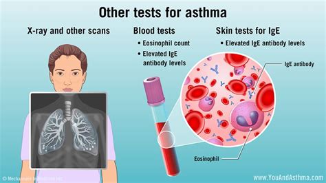 Other tests for asthma Your doctor might order an X-ray and other scans to look at your lungs ...