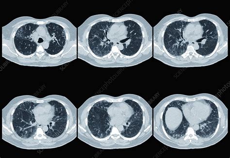 Interstitial lung disease, CT scan - Stock Image - C013/2184 - Science Photo Library