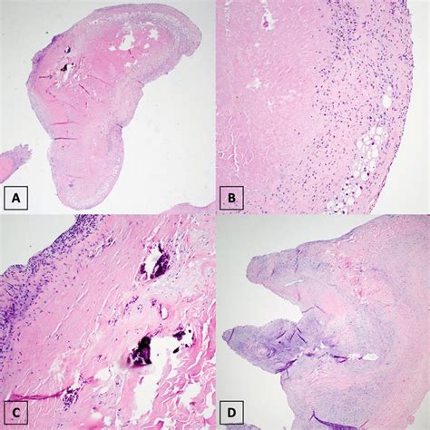 Histological evaluation of the papillary muscle. Histologic findings... | Download Scientific ...