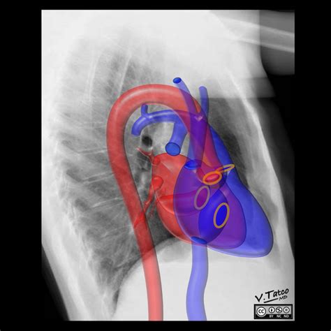 Radiopaedia - Drawing/X-ray Position of heart and great vessels in chest x-ray: right lateral ...