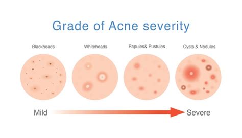 60 Acne Grades Images, Stock Photos, 3D objects, & Vectors | Shutterstock