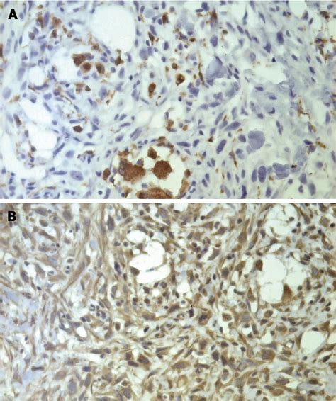 Figure 3 from A case of primary malignant fibrous histiocytoma of the pancreas: CT and MRI ...